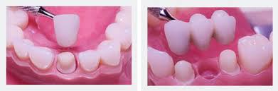 immediate dental implants