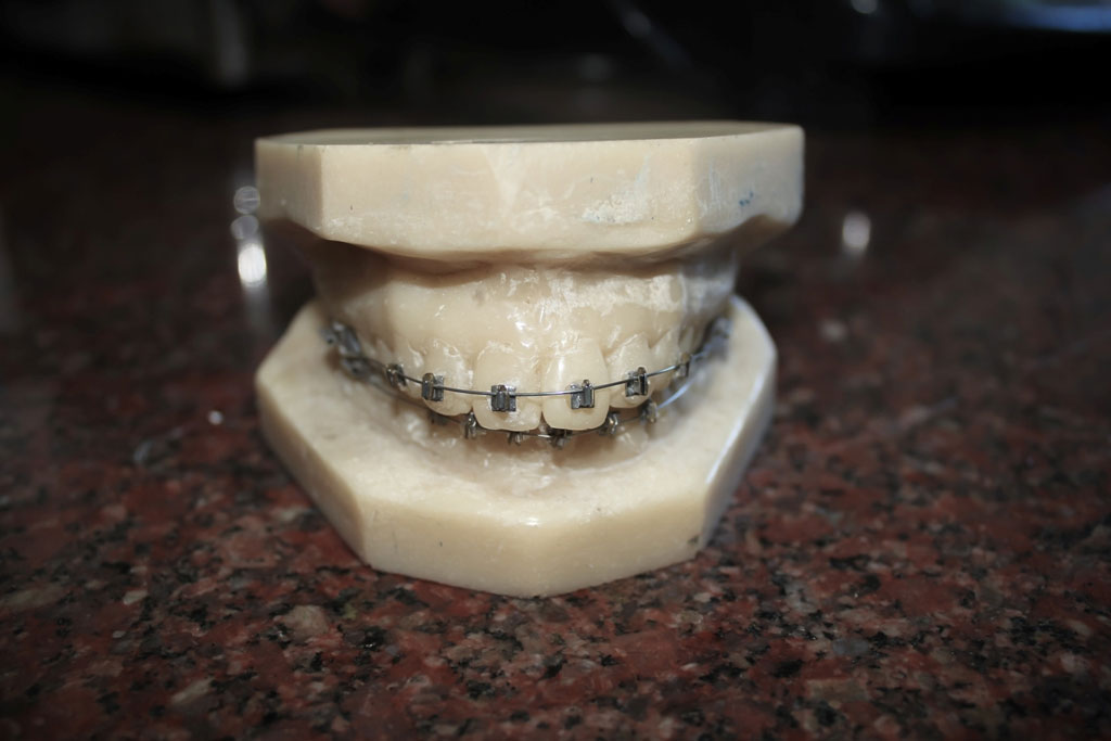 Cheap Dental Implants