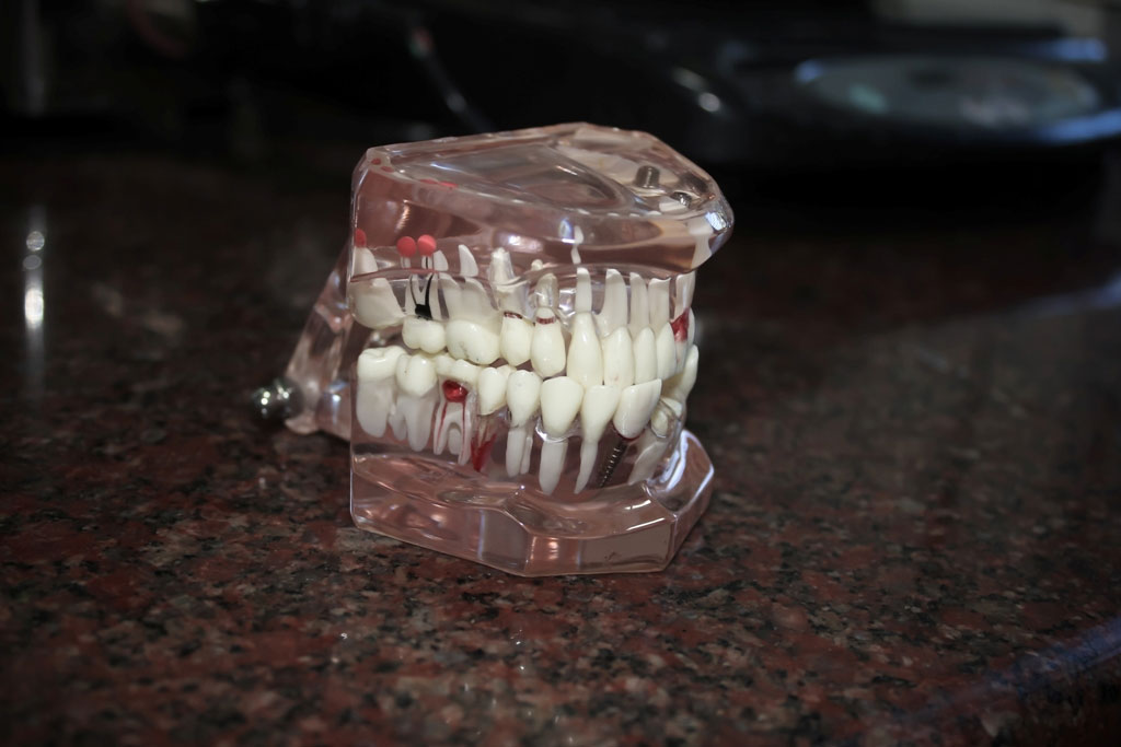 Cheap dental Implants India